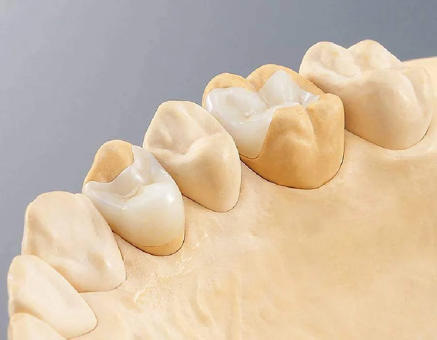 CEREC 3D Zug — Keramik-Zahnersatz in einer Sitzung