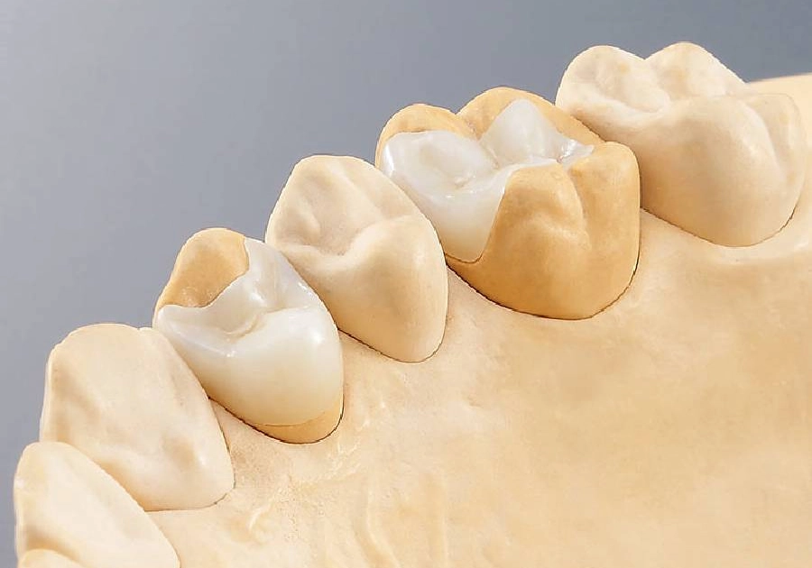Inlays und Onlays Zug — Keramikeinlagen