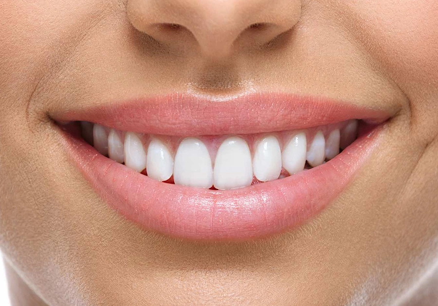 Schöne Zähne durch Veneers — Zahnärzte Neustadt Passage Zug