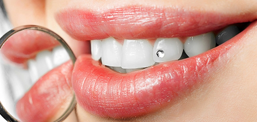Zahnschmuck — Tooth Gem beim Zahnarzt in Zug