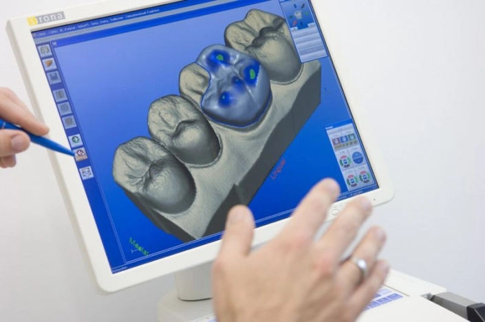 CEREC-Behandlung
